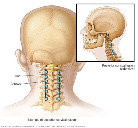 Spinal fusion - Drugs.com