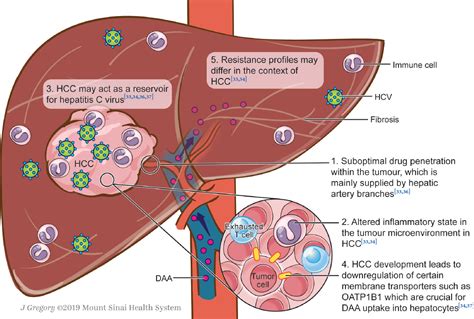 Management Of Concomitant Hepatocellular Carcinoma And Chronic