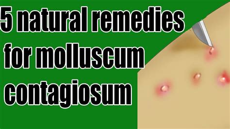 5 Natural Remedies For Molluscum Contagiosum Molluscum Contagiosum Treatment Youtube