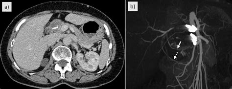 A Abdominal Enhanced Computed Tomography One Year After Treatment