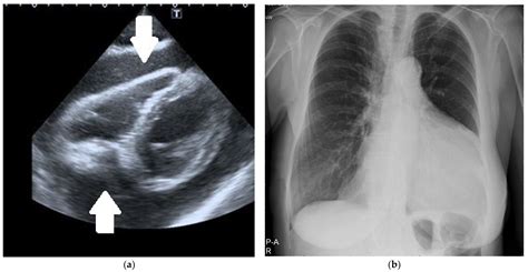 Diagnostics Free Full Text Large Pericardial Effusion—diagnostic