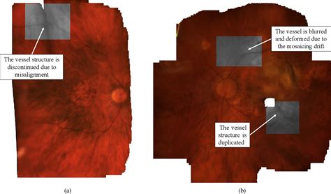 Figure 1 From Reducing Drift In Mosaicing Slit Lamp Retinal Images