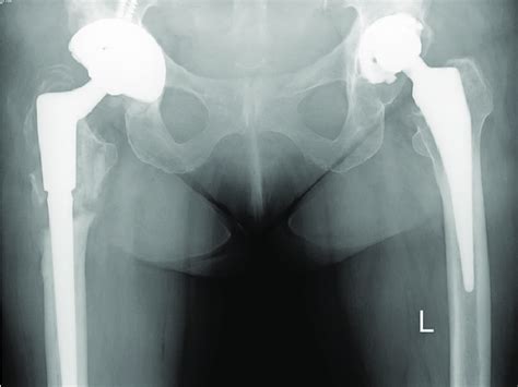 Preoperative X Ray Aseptic Loosening Of The Left Acetabular Component Download Scientific