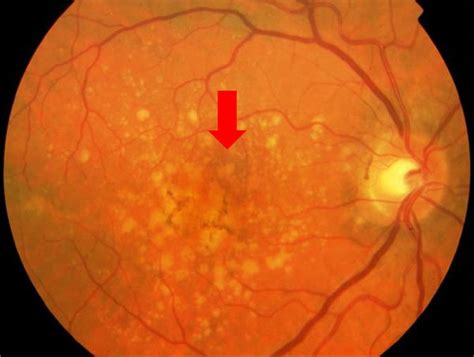 Clinical Retinal Fundus Photograph Of The Right Eye Macula Showing The