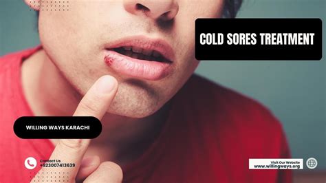 Cold Sores Treatment by willingwayskarachi - Issuu