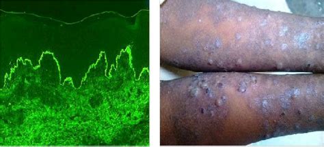 Dermatitis Herpetiformis Download Scientific Diagram