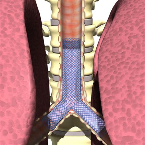 Y Tracheal Stent Com Ce Certification Y Tracheal Stent Com Ce