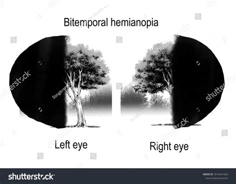 Different Patterns Visual Field Defects Neurological Stock Illustration 1813441426 | Shutterstock