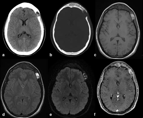 Spectrum Of Lytic Lesions Of The Skull A Pictorial Essay Insights