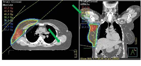 Figure 1 From A Rare Case Of Primary Carcinoma Of Axillary Accessory