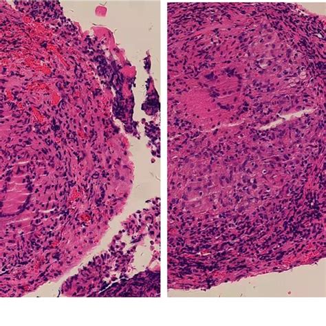 A B Histopathology Of Pleural Biopsy Specimen Showed Granulomatous