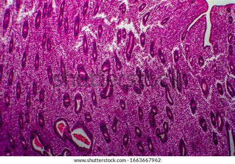 Endometrial Hyperplasia Light Micrograph Photo Under Stock Photo