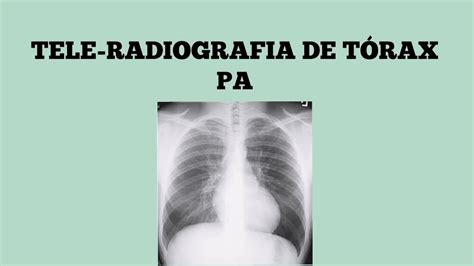 Proyección Pa De Tórax Tele Radiografia De Tórax Youtube