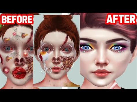 Asmr Maggot Infected And Big Acne Removal Deep Cleaning Animation