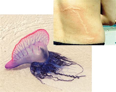 Jellyfish Sting - Symptoms, How To Treat A Jellyfish Sting