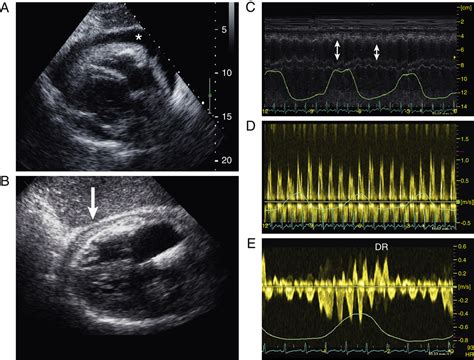 Effusive Constrictive Pericarditis After Pericardiocentesis Incidence