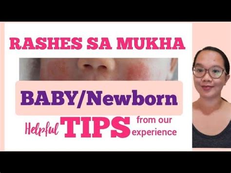 Rashes Sa Mukha Ng Baby O Sanggol Gamot Paano Mawala Ang Rashes Sa