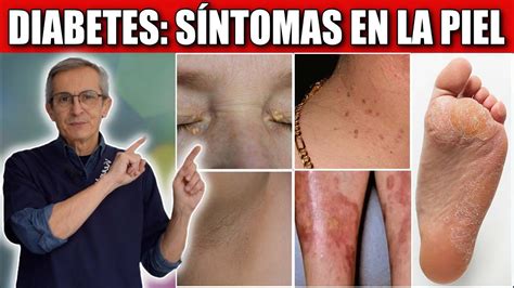 10 SINTOMAS De DIABETES En La PIEL YouTube