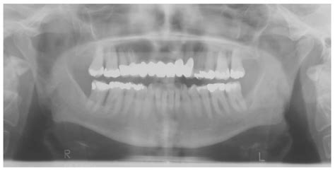 Ijerph Free Full Text Rare Diseases With Periodontal Manifestations