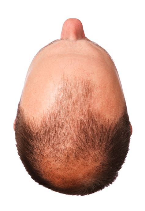 How To Prevent Going Bald Relationclock27