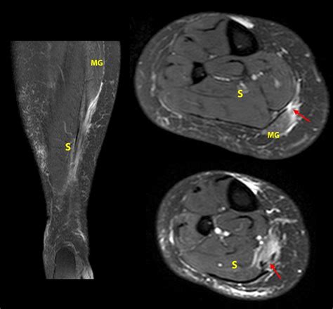 Calf Strain Mri