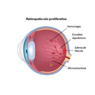 O que causa a retinopatia diabética Conheça a doença