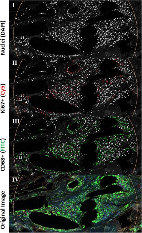 Proliferation Of Cells Within The Inflammatory Infiltrate Of The Download Scientific Diagram