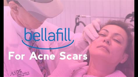 Bellafill Filler For Acne Scars Total Dermatology Youtube