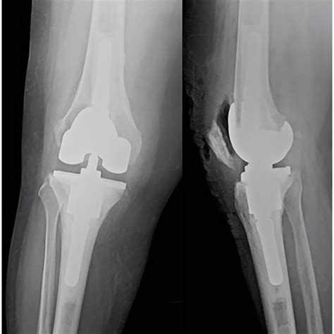 Standard Fixation For Easy Revision Cases Download Scientific Diagram