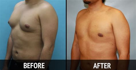 How To Get Rid Of Gynecomastia Naturally Without Surgery Get Rid Of