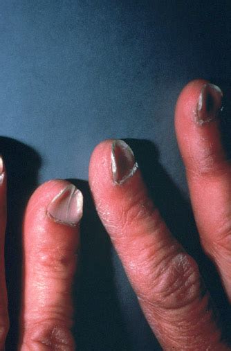 Iron Deficiency Nails Pictures Photos