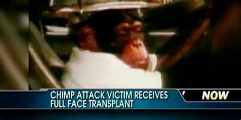 Chimp Attack Victim Receives Face Transplant Fox News Video