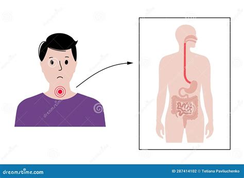 Dysphagia Medical Poster Vector Illustration Cartoondealer