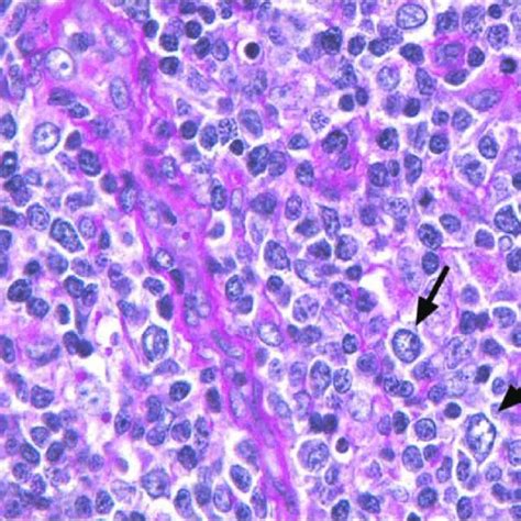 Special staining showing EBV-stained cells in lymph node biopsy sample. | Download Scientific ...