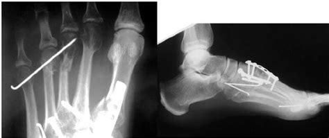 3Rd Metatarsal Fracture Healing Time / Toe And Forefoot Fractures ...