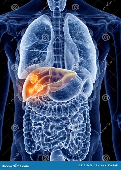 Liver Cancer Stock Illustration Illustration Of Human 73539458