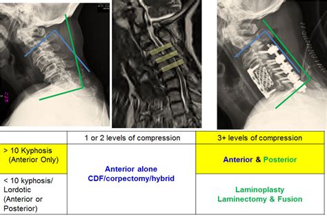 Cervical Disc Disorder With Myelopathy