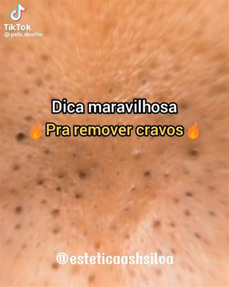 Dica Maravilhosa Para Remover Cravos E Ter O Melhor Tratamento Para A