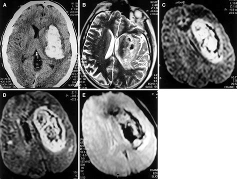 Ischemic Vs Hemorrhagic Stroke Mri