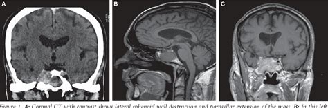 Figure 1 From Hepatocellular Carcinoma Presenting As An Isolated Sphenoid Sinus Lesion A Case