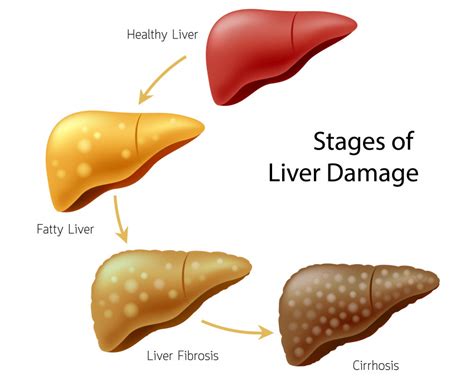 I was diagnosed with fatty liver disease. What is it, and is this serious? - Hep