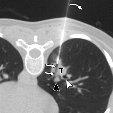 Ct Guided Core Biopsy Of Lung Lesions A Primer Ajr