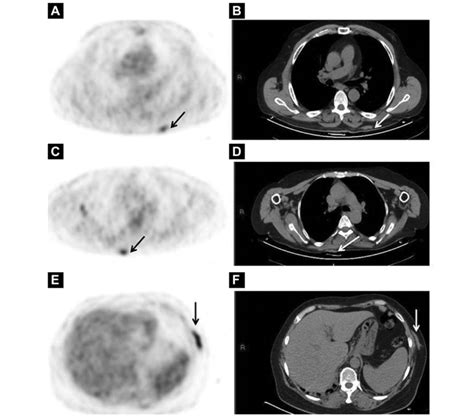 A Patient With Cutaneous Marginal Zone Lymphoma An Indolent B Cell Download Scientific Diagram