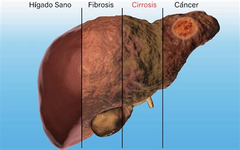 Qu Es La Cirrosis Hep Tica Conoce Esta Peligrosa Enfermedad