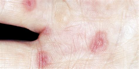 Erythema Multiforme Target Lesions