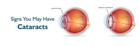 Know The Signs Of Cataract And Eye Health