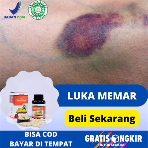 Obat Luka Memar Menghilangkan Luka Memar Bengkak Di Wajah Dan Kepala