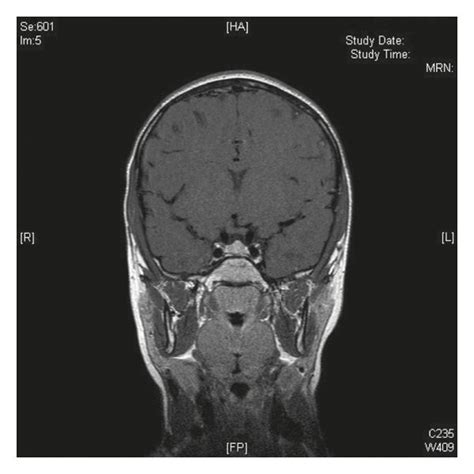 Coronal post-Gadolinium brain MRI image showing a normal pituitary ...