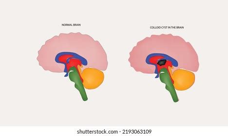 406 Cyst Brain Images, Stock Photos & Vectors | Shutterstock