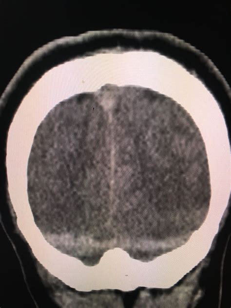 Dural Sinus Thrombosis Sss Delta Triangle Sign And Bilateral